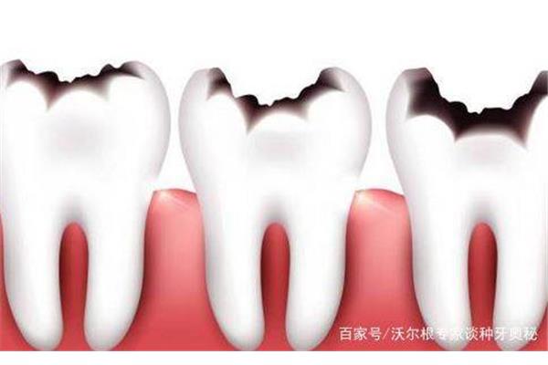 齲齒補牙后疼痛一般持續多久,用牙粉補牙能持續多久?