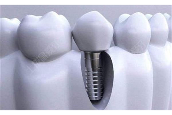 種植牙的周期是多久,拔牙和種植牙的流程和周期是多久?