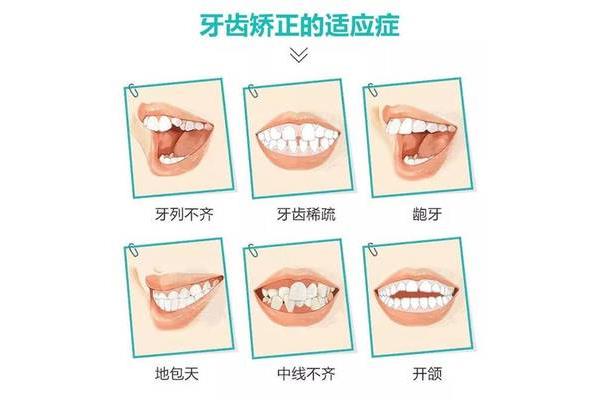 牙齒拉中線需要多久,牙齒矯正中線需要多久?
