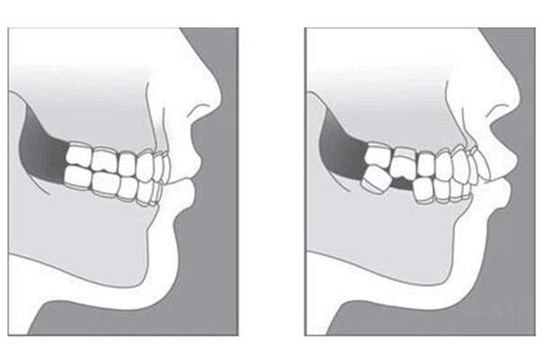 拔門牙后多久能裝固定義齒