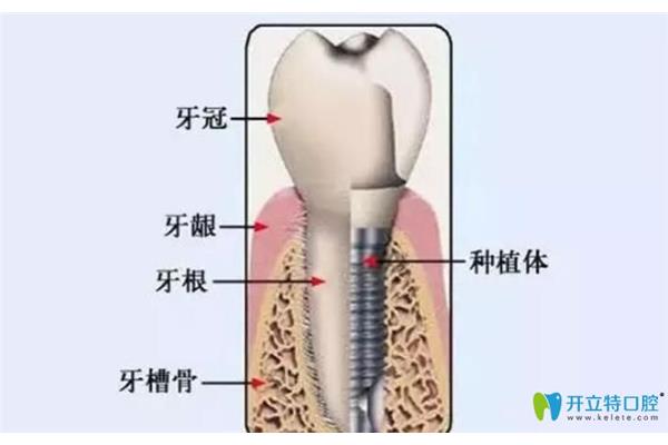 種植牙和植骨消腫需要多少天?種植牙植骨后什么時候消腫好?