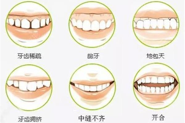 牙齒矯正需要戴多久的牙套,牙齒矯正需要戴多久的牙套?