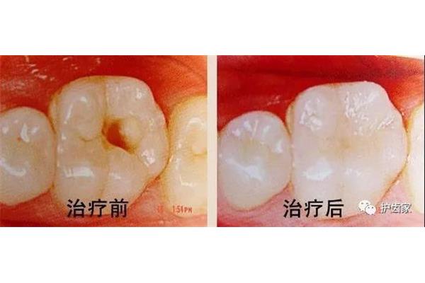 補一顆牙的洞需要多久,補一顆牙的洞需要多久?