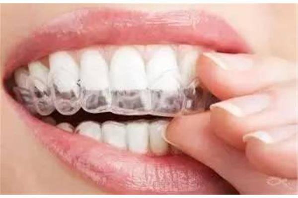 正畸牙齒可以戴多久牙套?正畸牙齒可以戴多久牙套?