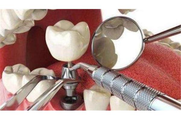 種植牙裝牙冠要多久,種植牙最早可以得到很長時間的牙冠