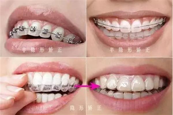 牙齒矯正戴多久牙套,牙齒矯正一般戴多久?