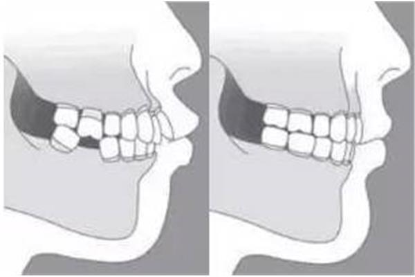 牙齒缺失多久會移位