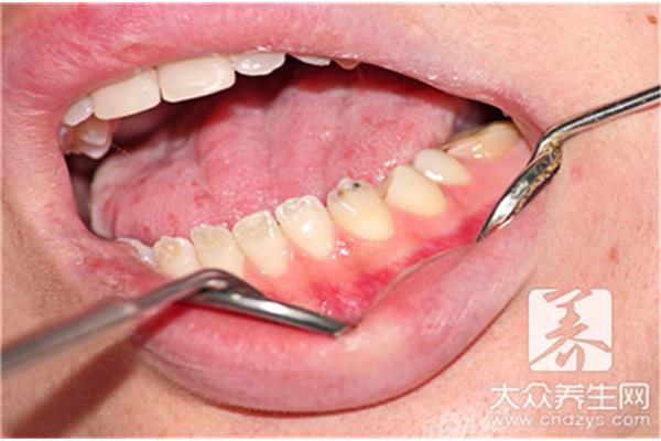 牙周病治療后多久可以種牙