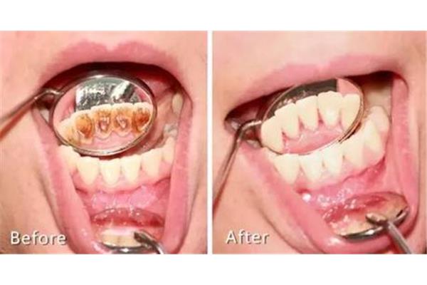 洗完牙多久牙齦恢復