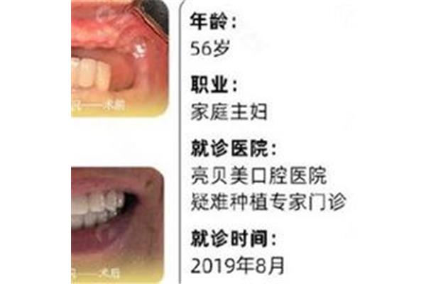 二期種植牙后多久戴牙冠,二期種植牙后多久戴一顆牙?