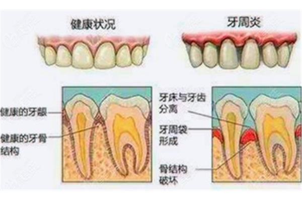 牙周炎不治療多久掉牙,慢性牙周炎多久掉牙?