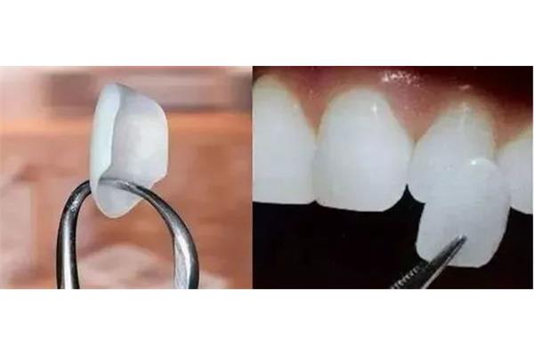 樹脂牙貼面多久會變色,樹脂牙貼面后會有后遺癥嗎?
