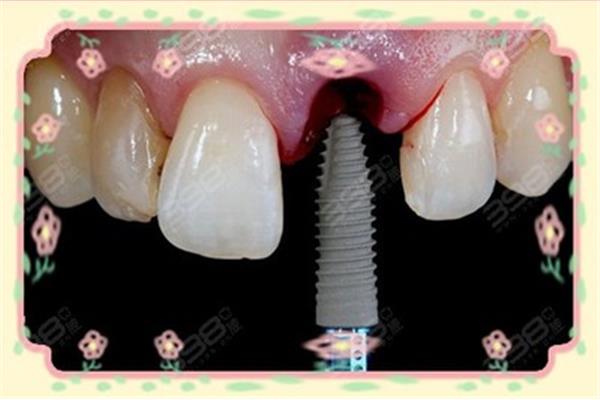 種植一顆牙齒能維持多久
