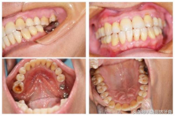 種牙二期手術多久帶牙冠