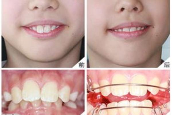 生完孩子多久可以矯正牙齒,孩子矯正牙齒可以很久