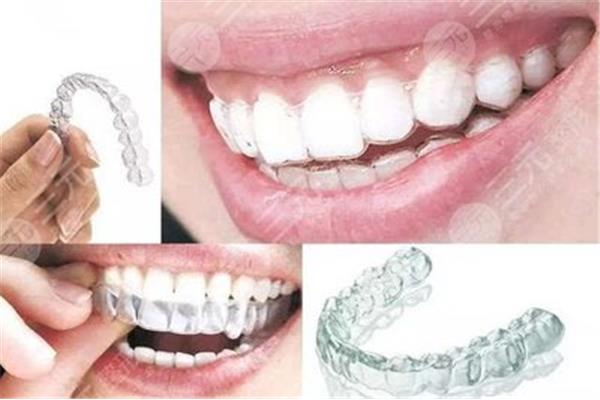 拔牙后牙齒之間的縫隙多久可以閉合?拔牙好還是不拔牙好?