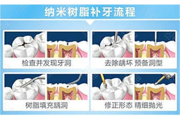 樹脂補牙和臨時補牙能堅持多久?
