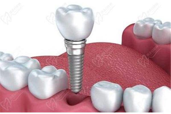 根管治療后還是會疼補牙后幾天疼痛是正常的?