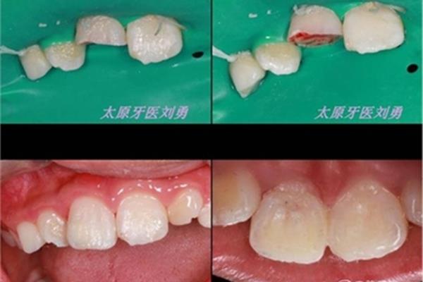 牙根炎癥多久能恢復,牙根漏怎么恢復?