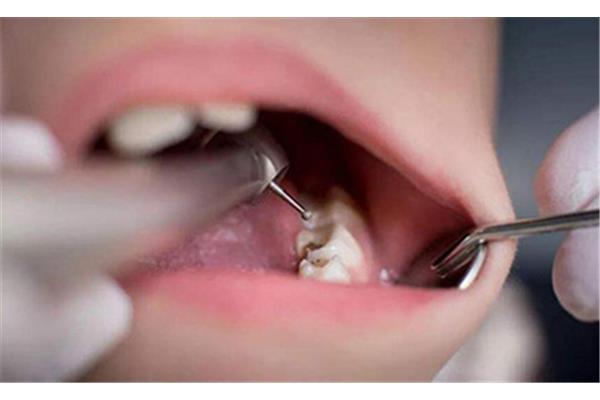 拔神經補牙要多久,殺神經補牙的步驟