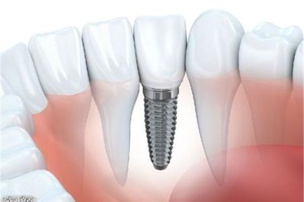正畸牙齒固定后多久可以拔除,松動的牙齒固定后可以保留多久?