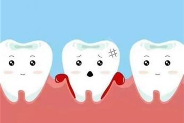 多久能再拔一次牙?拔牙和間隔多長時間?