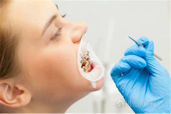用牙牽引器牙疼正常嗎?矯正畸形牙用哪種方法比較好?