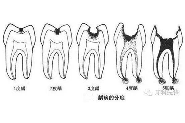 醫院牙醫當天補一顆牙要多久,牙痛要補多久?