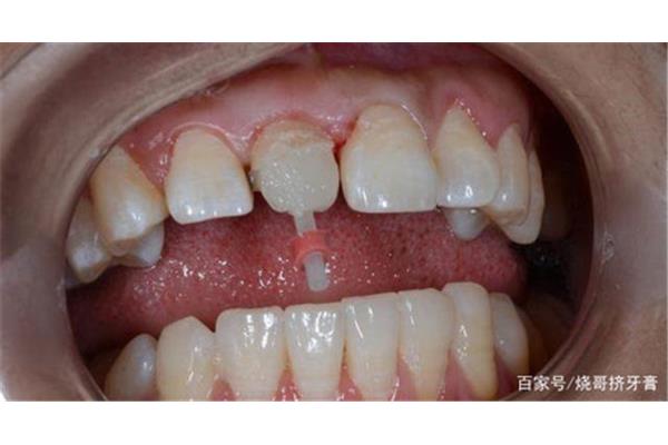 樁核冠可以用多久來修復牙齒,根充后可以修復多久?