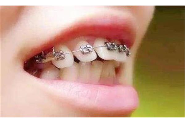 骨牙混合齙牙和齙牙箍牙多久能看到效果