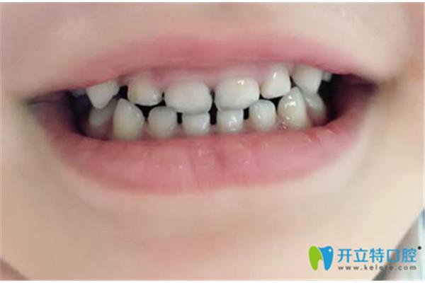 隱形牙套戴牙套需要多久?孩子戴牙套一般要多久?
