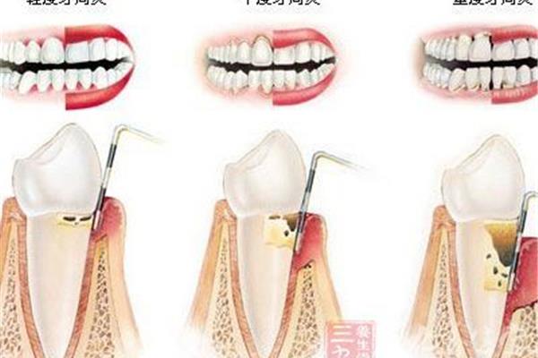 牙齒矯正和牙齒矯正的時間是多久?