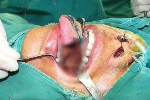 舌白斑手術需要住院嗎?白內障手術需要住院多久?