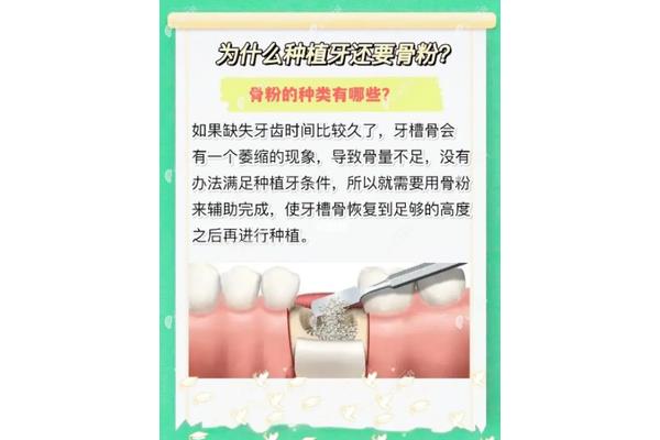種植牙骨粉需要多久才能變成骨頭,種植牙植骨需要多少天才能消腫?