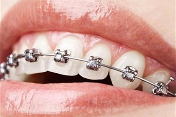 戴牙套多久有效果?隱形牙套戴多久會有效果?