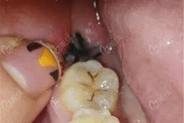 拔牙窩要多長時間,拔智齒的洞要多長時間?