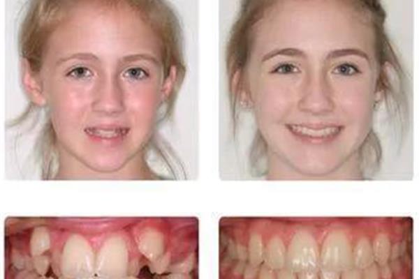 二十多歲整牙齒要多久?矯正牙齒需要多長時間?