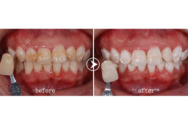 如何修復牙齒,一篇關于中醫的報道