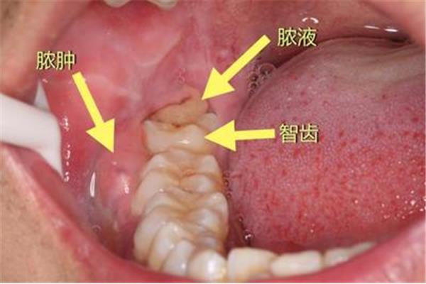 牙齒固定后多久可以吃東西,牙齒固定后多久可以恢復?