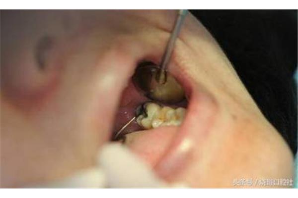 下頜智齒拔掉后需要多長時間恢復,需要多長時間消腫?