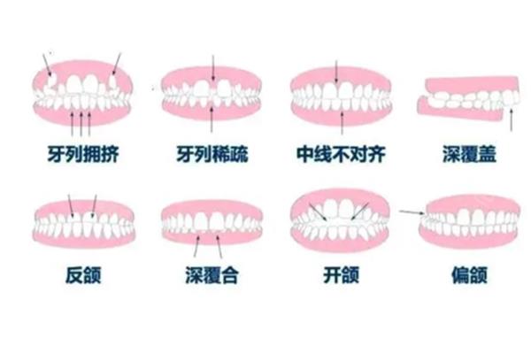 舌側矯正牙齒多久排列