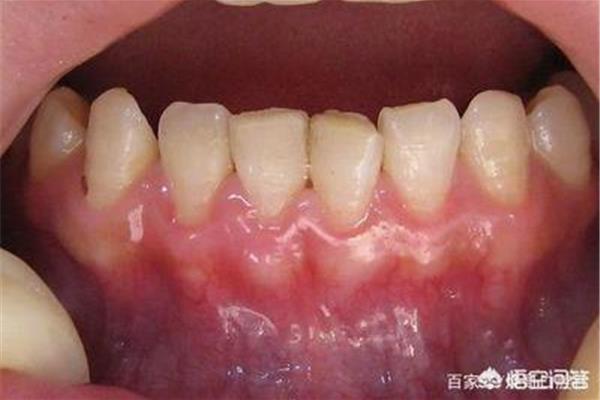 口腔潰瘍牙痛多久能好?牙痛在牙齒周圍腫脹