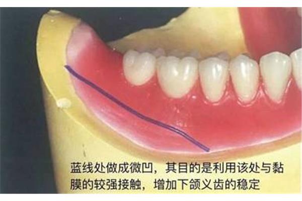 局部義齒和全口義齒的區別,吸附義齒和普通全口義齒的區別