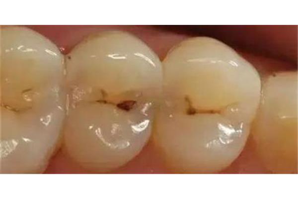 補一般的牙洞需要多久