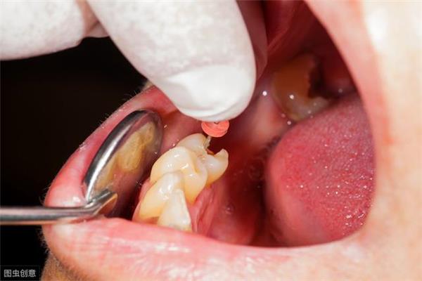 補牙的填充物可以多久