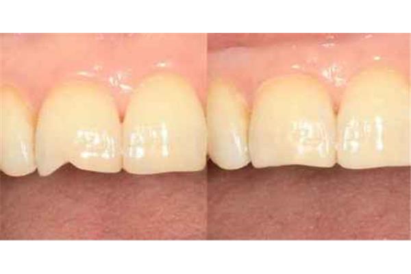 復合樹脂可以刷牙多久?用樹脂填充可以刷牙吃多久?