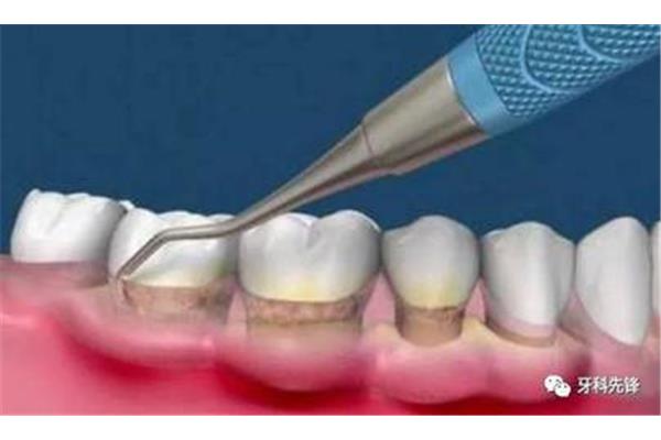 洗完牙多久檢查一次怕感染傳染病?關于洗牙的一些問題