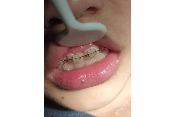 孩子矯正牙齒需要多長時間孩子矯正牙齒需要多長時間?