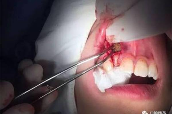 拔牙后傷口需要多長時間愈合?拔完牙一般要多長時間才能插好牙?