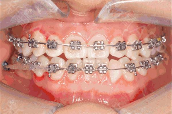 拔牙種植牙后多久可以矯正牙齒?